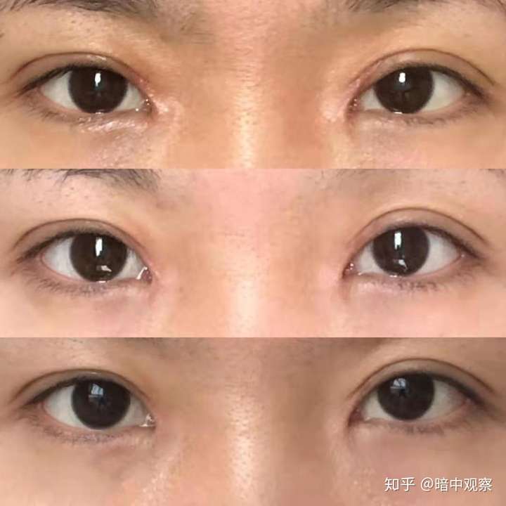 以下是沈阳一位医生的双眼皮案例,可以自行参考一下
