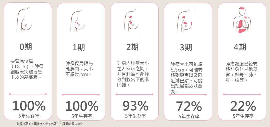 乳腺癌该如何分类 知乎