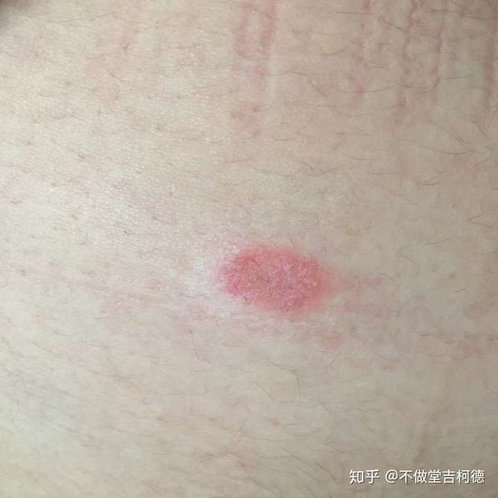 猫癣传染人如何才能治好