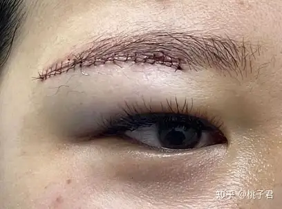 公布了提眉一至七天效果图提眉术后17天恢复图