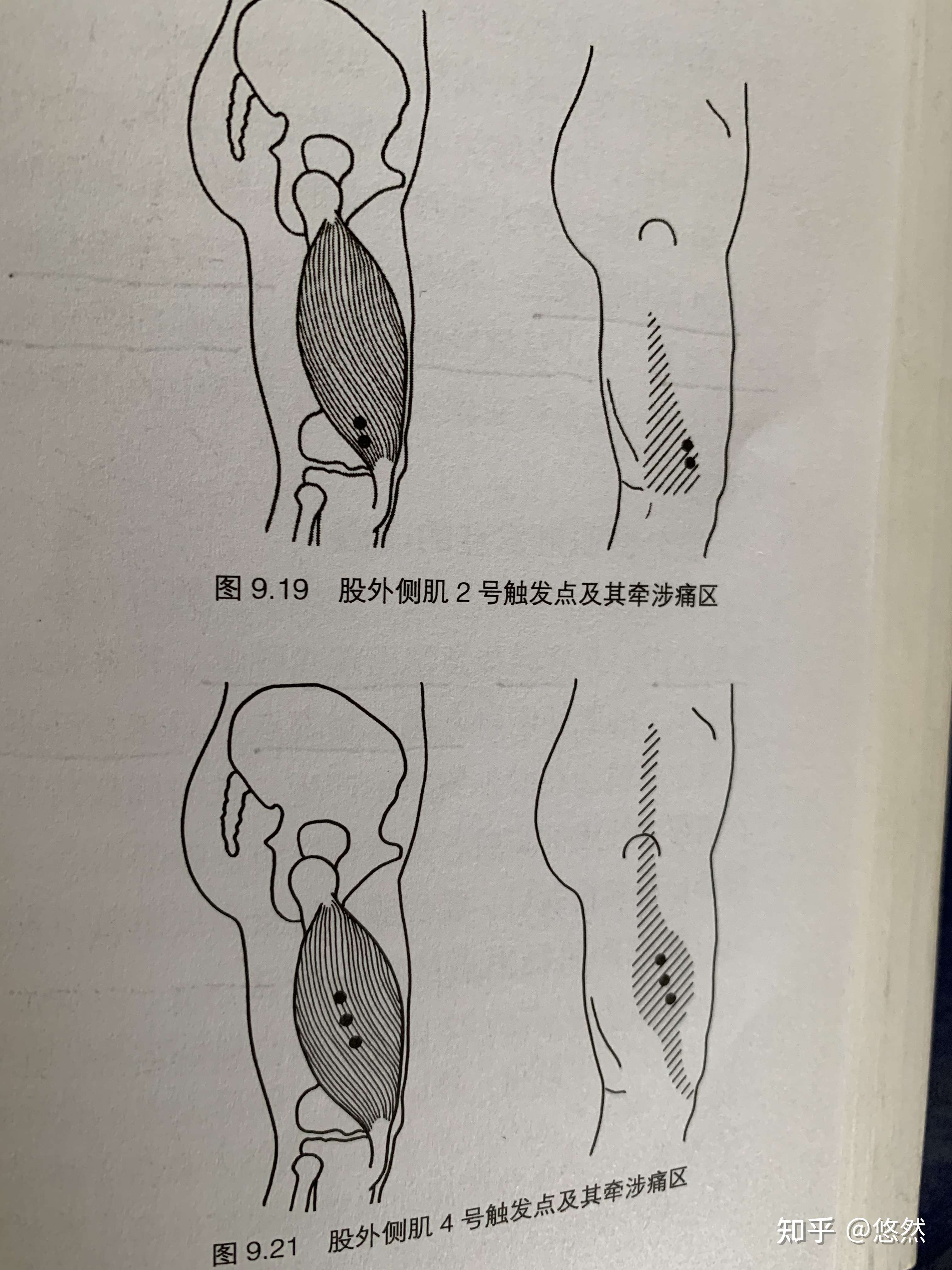 悠然 的想法: 右腿外侧紧张好久了,松解了阔筋膜张肌,… - 知乎