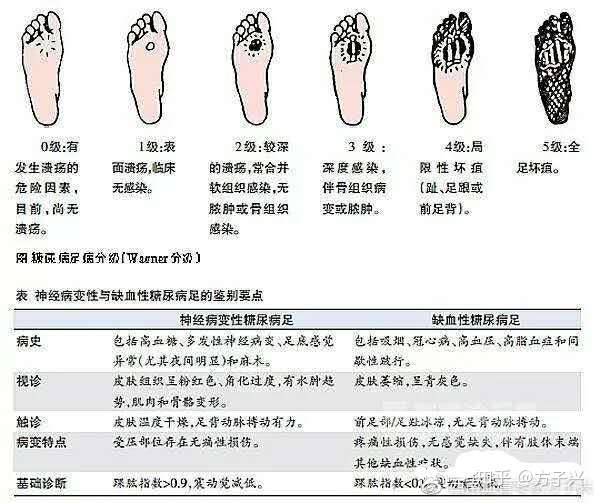 有了糖尿病足 身体会出现3个症状 知乎