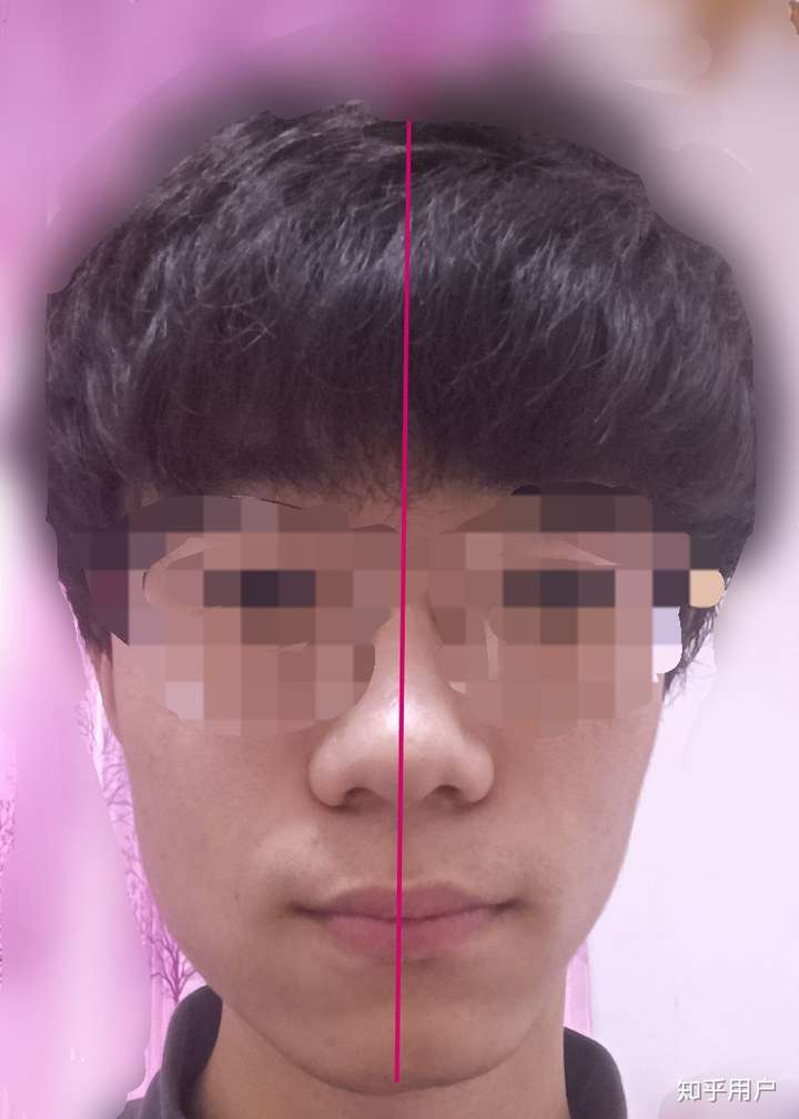 我的脸真的很不对称 ,大小脸非常严重 ,怎么办?