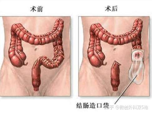 没有肛门了 造口很恐怖 大肠癌术后如何在家护理 肠造口 知乎