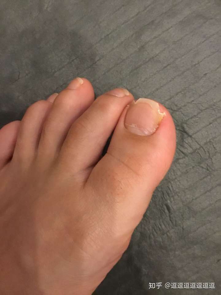 脚趾大拇指指甲两侧往肉里长怎么办啊?