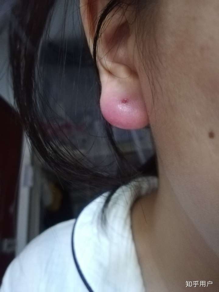 打耳洞肿了流血发炎戴茶叶棍可以吗 ?