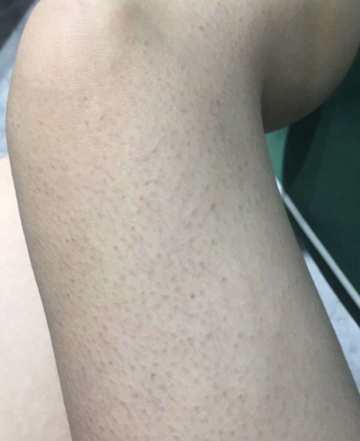 把腿上的鸡皮疙瘩去除(怎么样去除腿上的鸡皮疙瘩)
