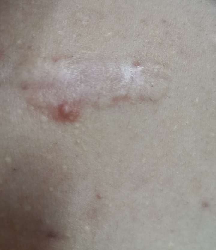 但我胸前还是会长痘,感觉随时还会再来一个疤痕(ノДt) 我是个很懒的