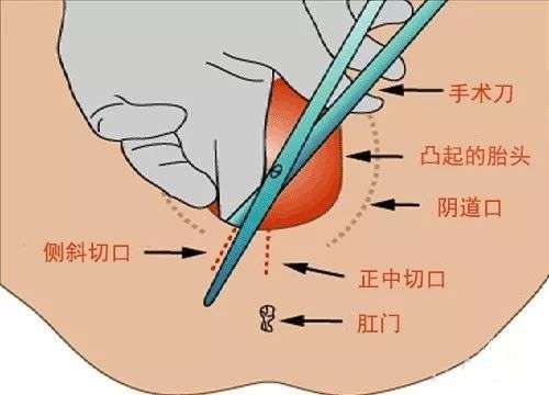 会阴侧切 顺产时必须挨这一刀吗?