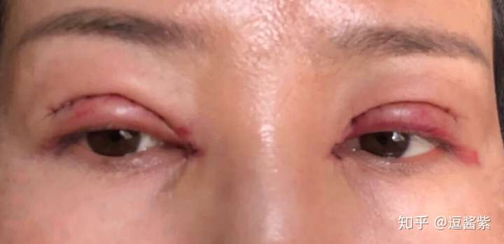 双眼皮开眼角眼部凹陷填充提肌眼综合失败了吗