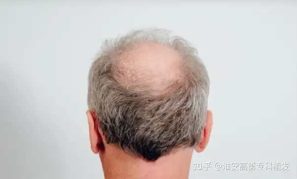 增加雄激素性秃发症状的因素? - 知乎