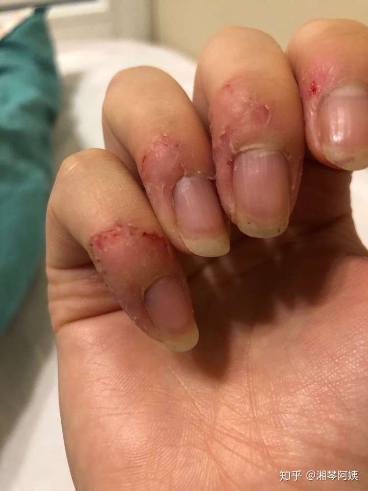 咬手皮是一种怎样的心理?