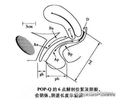 pop-q評分系統可以更精準地評估盆腔器官脫垂的程度,該系統是目前最