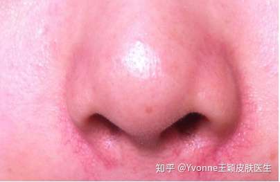 鼻翼两侧发红怎么办 知乎