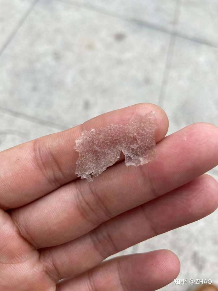 见过的最大头皮屑多大?