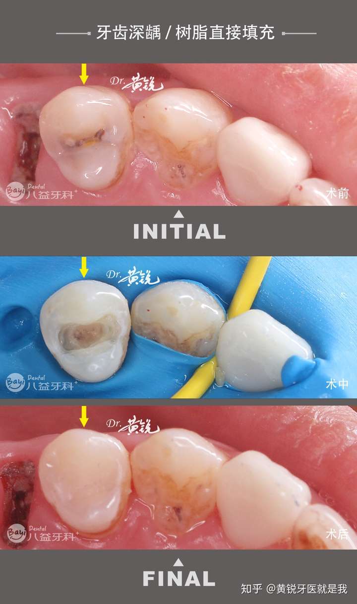 牙齿深龋树脂直接填充