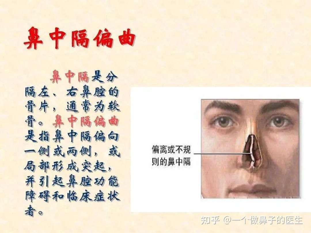 鼻子的鼻中隔偏曲矫正 功能与美观可以二者兼得 知乎