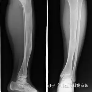 骨纤维结构不良是骨肿瘤吗?孩子高发,怎么才能发现呢?