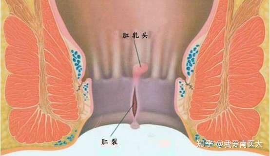 痔疮上厕所屁股痛上完后屁股也一直刺痛没有便血摸着屁股上有一小块肉