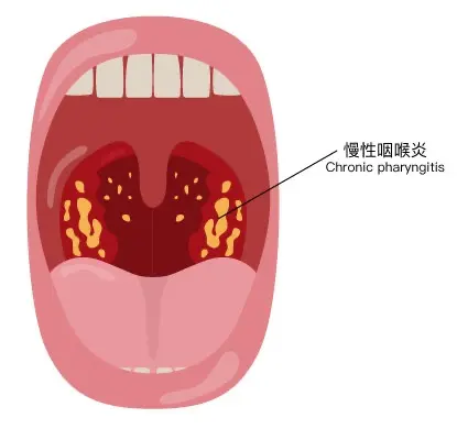 如何预防咽炎?