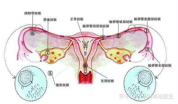 宫外孕的症状早知道 才能做好预防工作 知乎