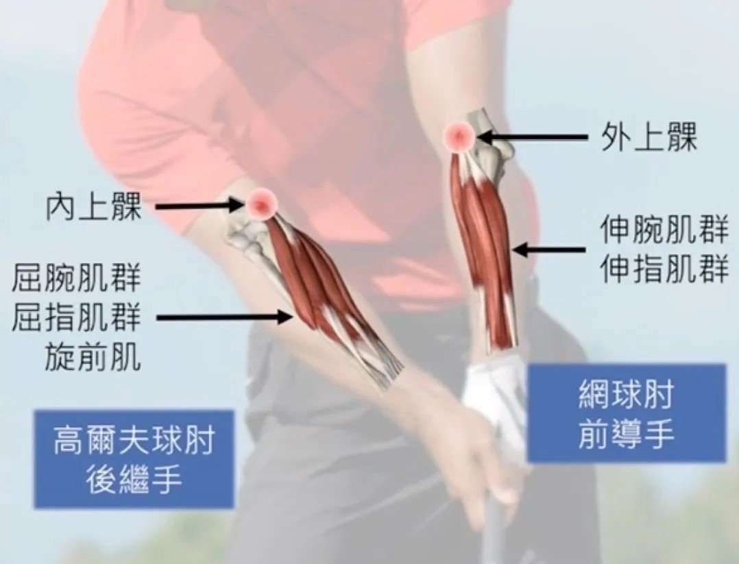 高尔夫的肘部伤害 高球人必知 知乎
