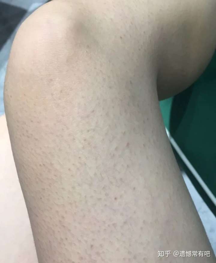 手臂鸡皮肤可以挤吗(鸡皮肤用手挤了会怎样)