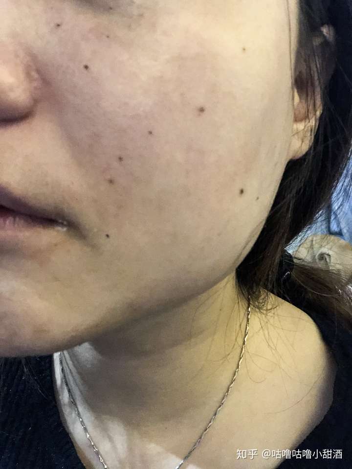 有没有必要去点痣啊?