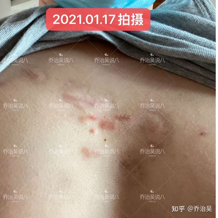 疤痕体质留的疤是不是一辈子的?