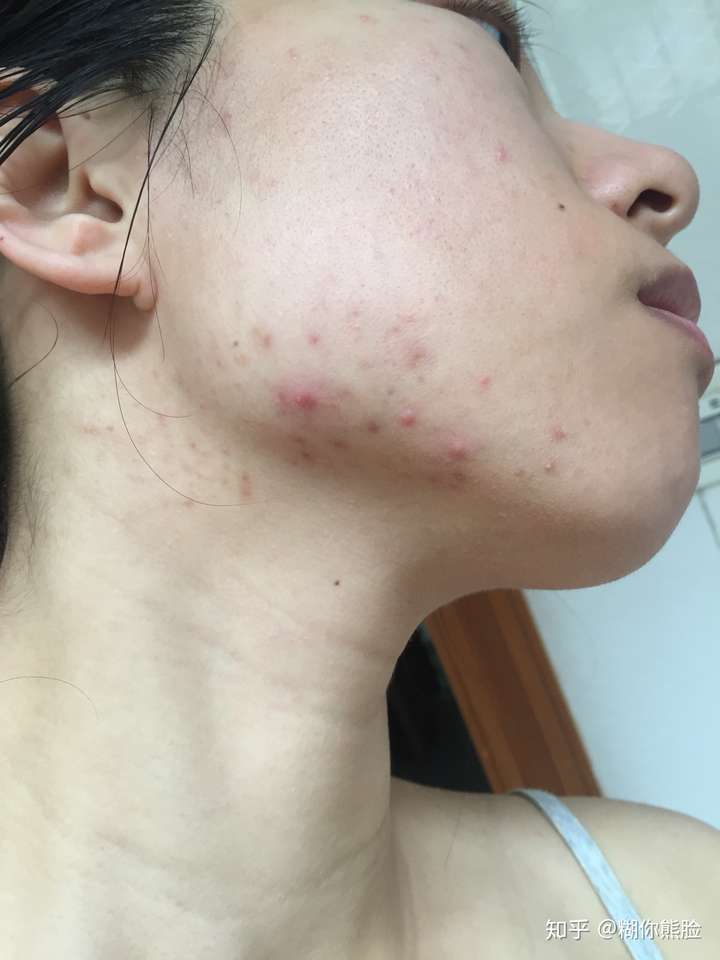 下巴和脖子交界处总长痘痘是什么原因该怎么办