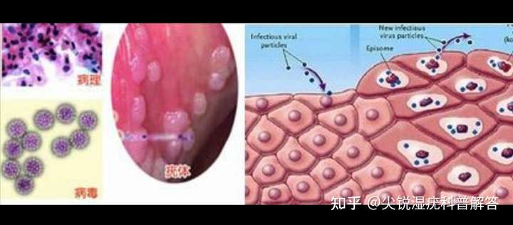 尖銳溼疣怎麼完全治療?