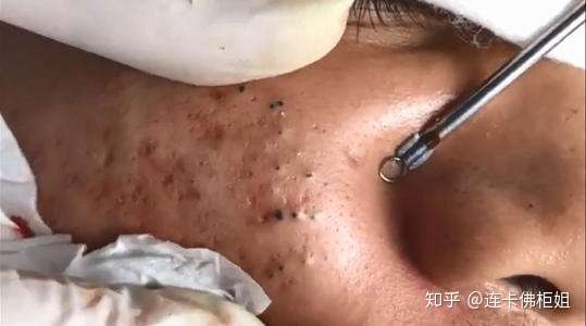 粉刺针会不会弄得毛孔越来越大