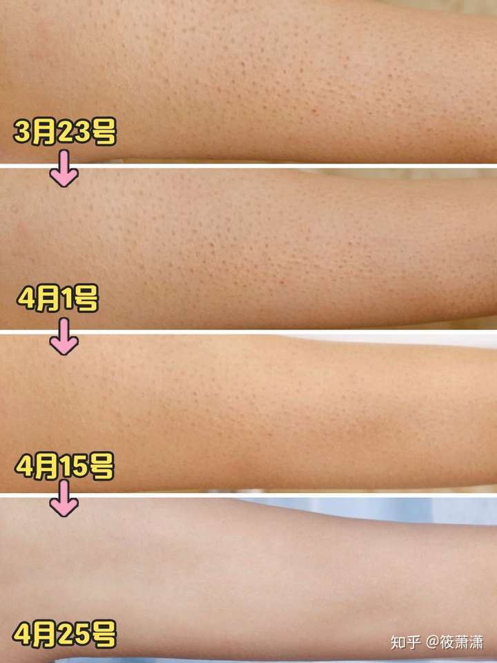 鸡皮肤不能去除吗(怎么可以去除鸡皮肤)