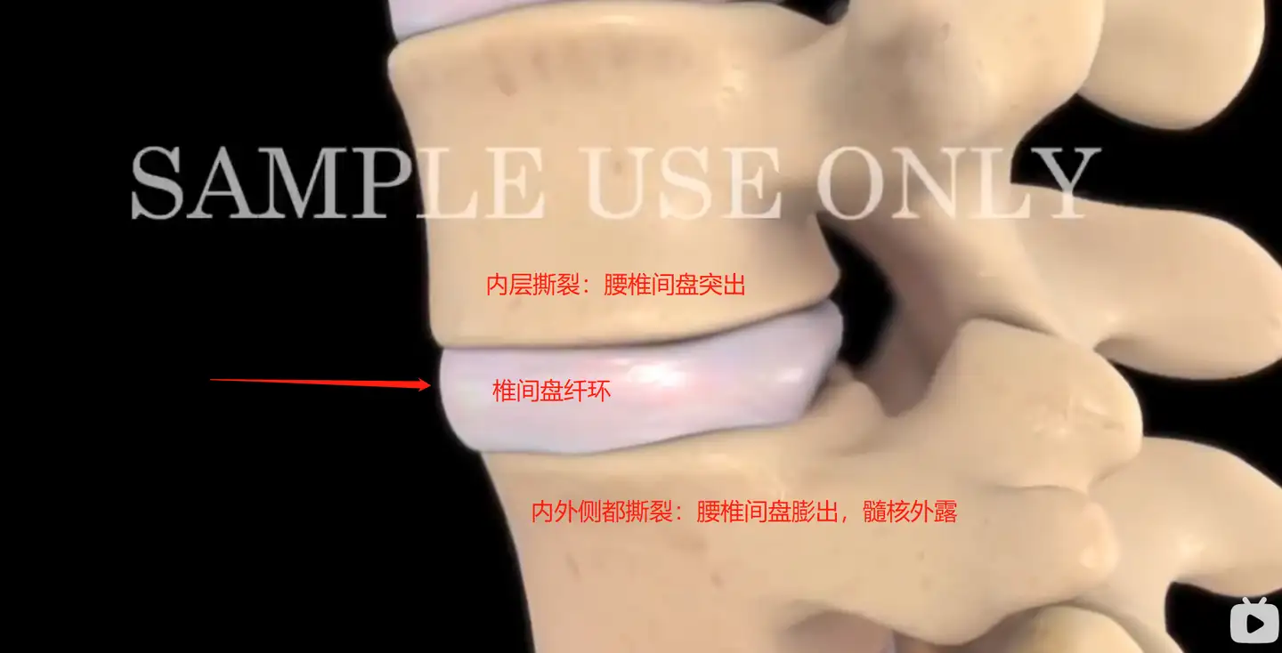 腰椎间盘突出症的自我治疗 患者版 知乎