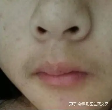 女生長唇毛是什麼原因有哪些脫唇毛的方法