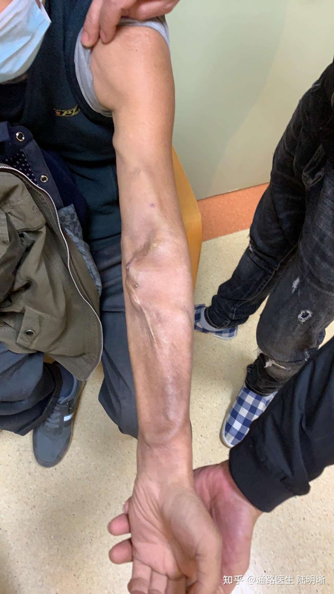 人工血管外渗出导致人工血管塌陷 知乎