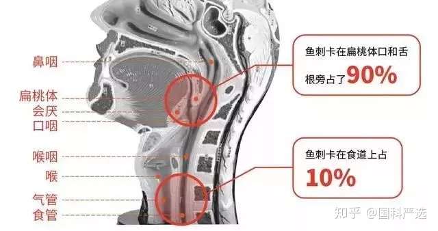 鱼刺卡喉咙 喝醋 吃馒头吞饭有用吗 答案全在这 知乎