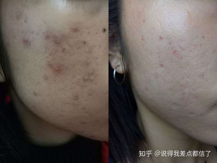 怎么样才能不长痘痘 知乎 怎么样才能不长痘痘 知乎