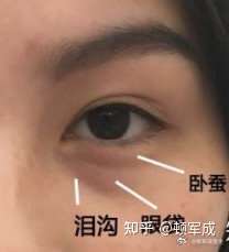 谁能告诉我这眼睛底下这东西的叫啥?是眼袋还是卧蚕啊?