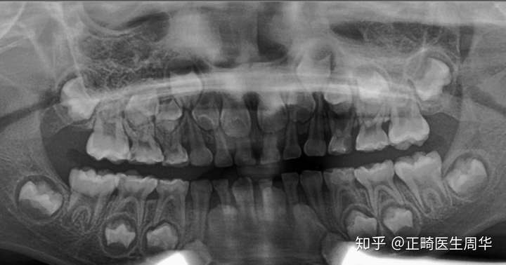 关注问题 67 写回答 牙齿 蛀牙