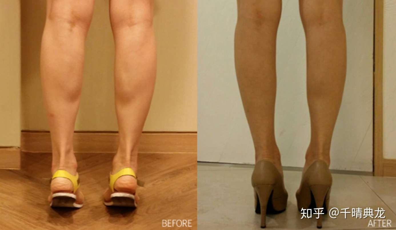 肌肉型和脂肪型的小腿分别要怎么瘦下来 知乎