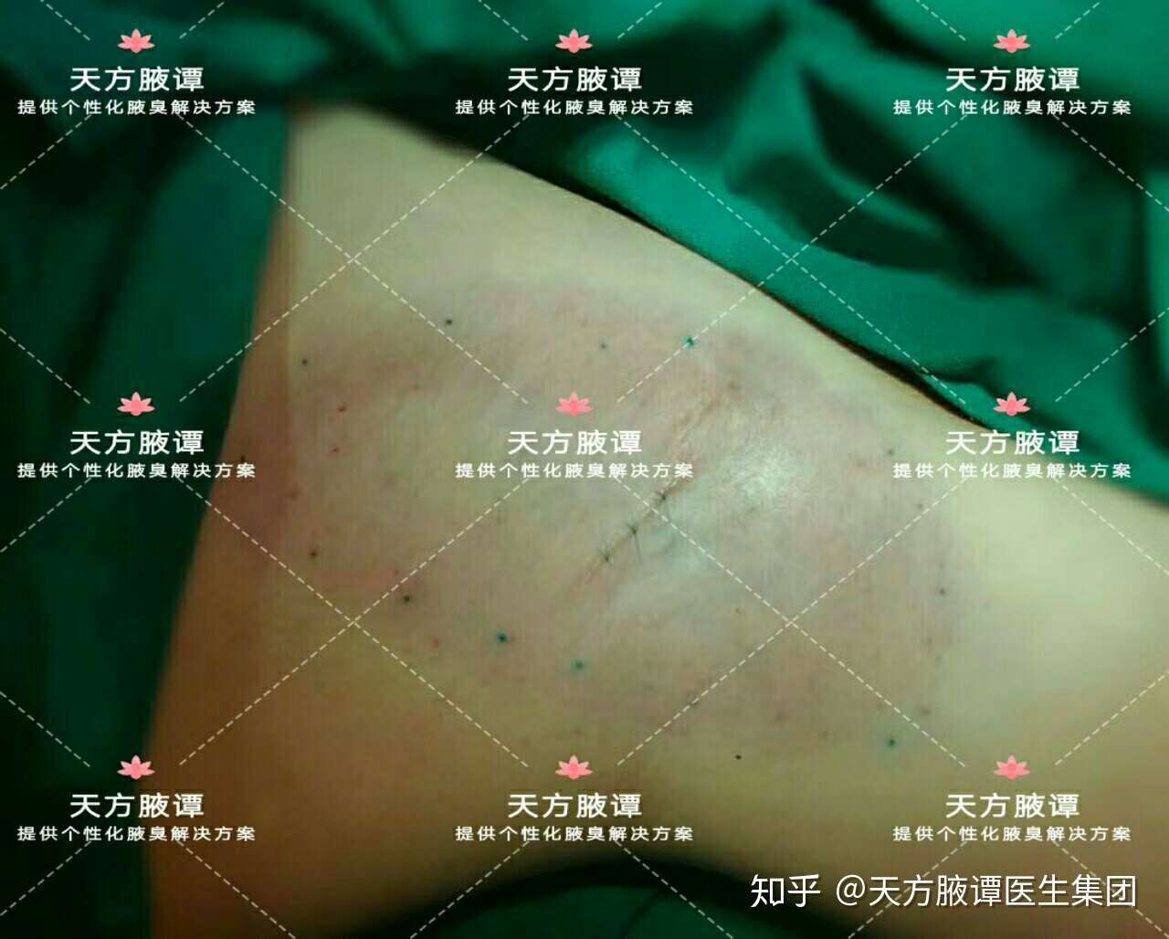 一千零一腋之949大汗腺的範圍在盲視下很難界定所以直視下手術切除大