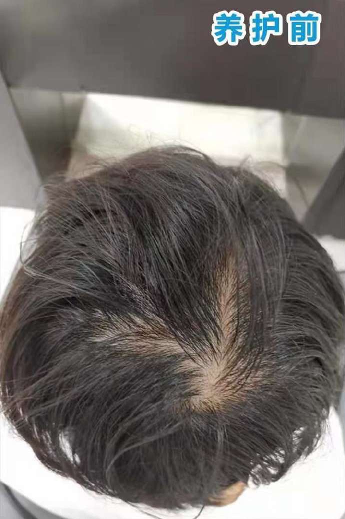 毛发医生徐鲁 的想法: 男性雄激素脱发(aga)头顶稀疏 