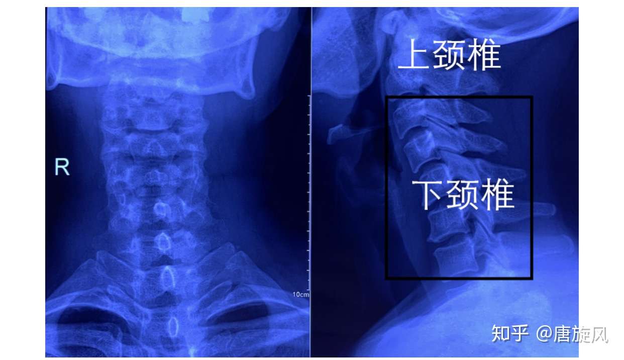 颈椎做了手术以后 活动度还剩下多少 对日常生活会不会有影响 知乎