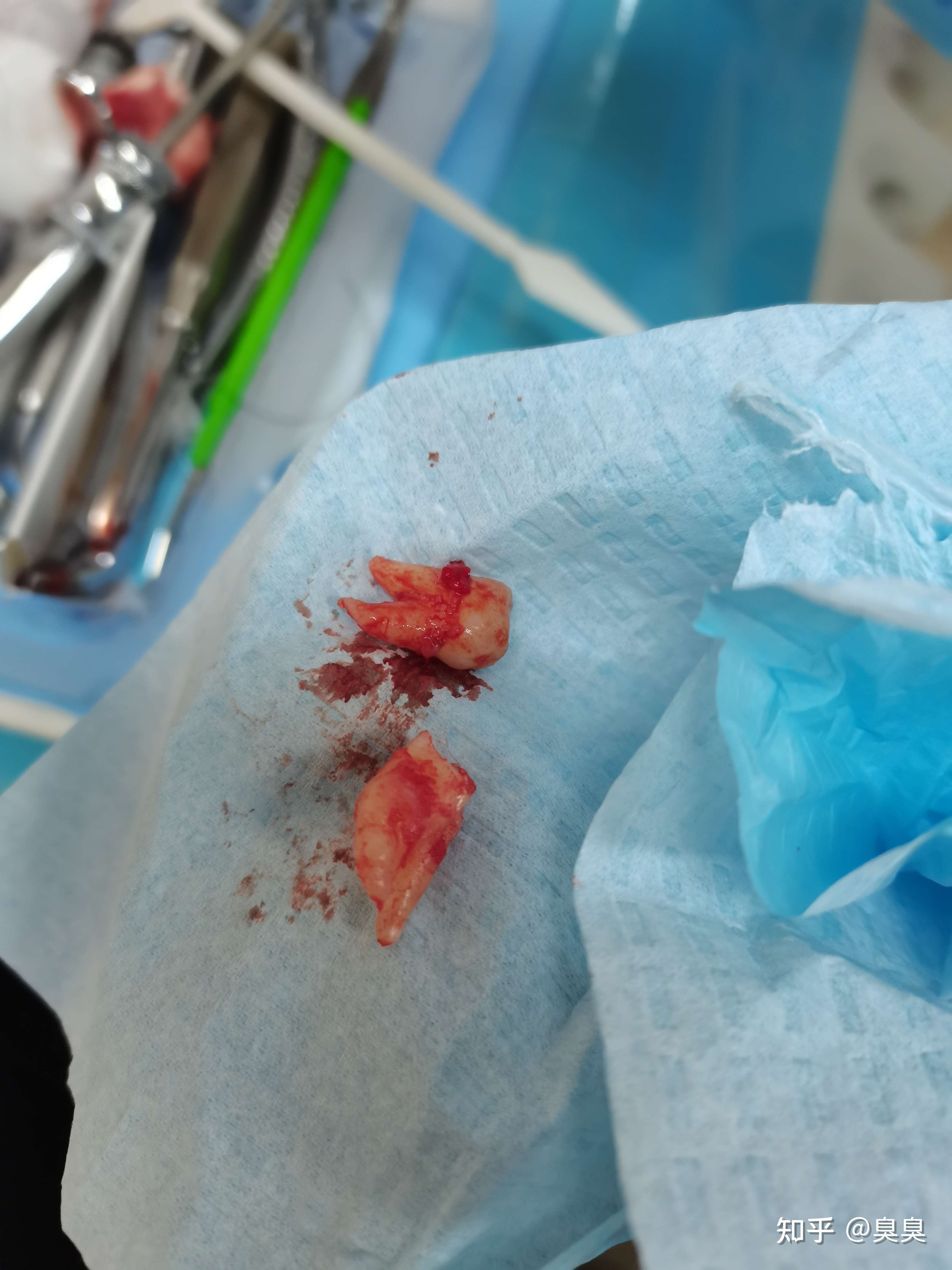 臭臭 的想法: 上周六拔了两颗智齿,那滋味不想再经历一… - 知乎