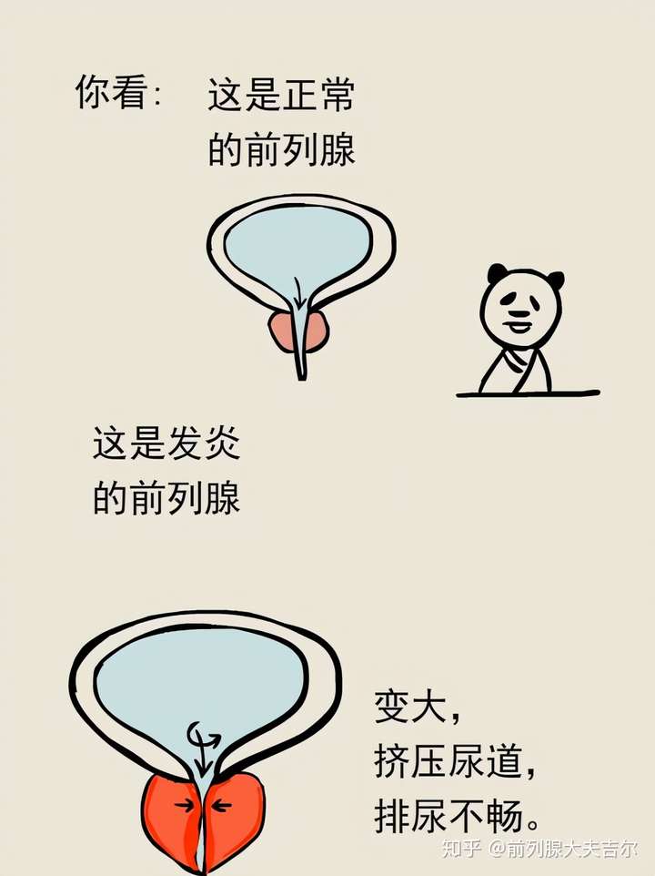 男性患上了前列腺炎后需要禁欲吗看一下这位患者的案例