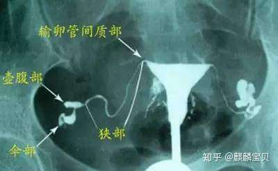 输卵管造影之后,多久可以怀孕?插图(1) v2-6b7c760b57686d17593d76b71db44115_720w.jpg插图(1)