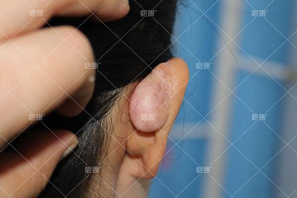 右耳术后瘢痕疙瘩，2次手术后均复发，想彻底治愈，一定要结合有效的预防 
