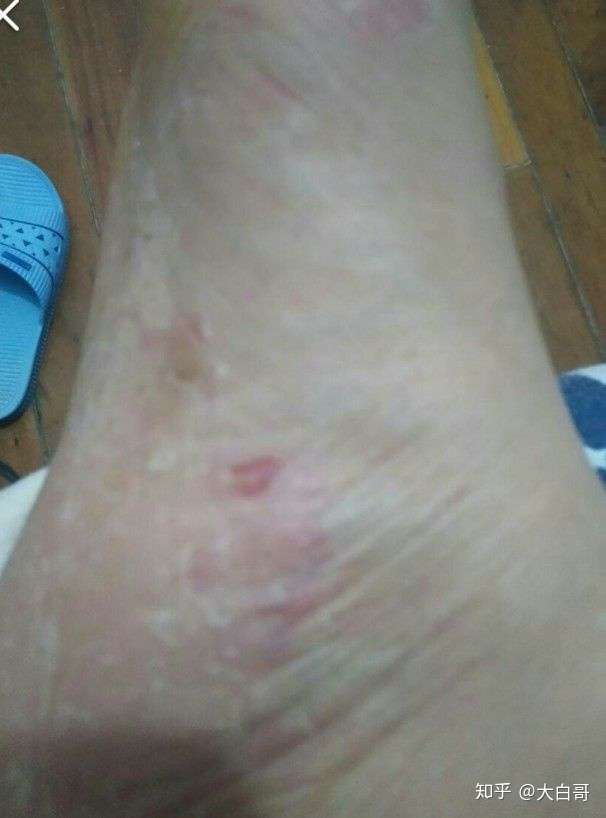烂脚丫怎么引起的危害是什么 知乎