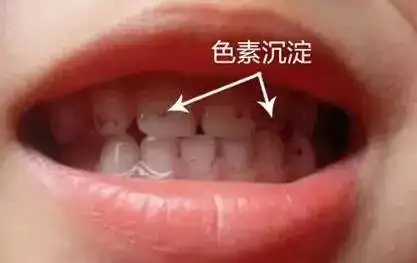 小朋友牙齿上的黑色素能去掉吗看晚了后悔